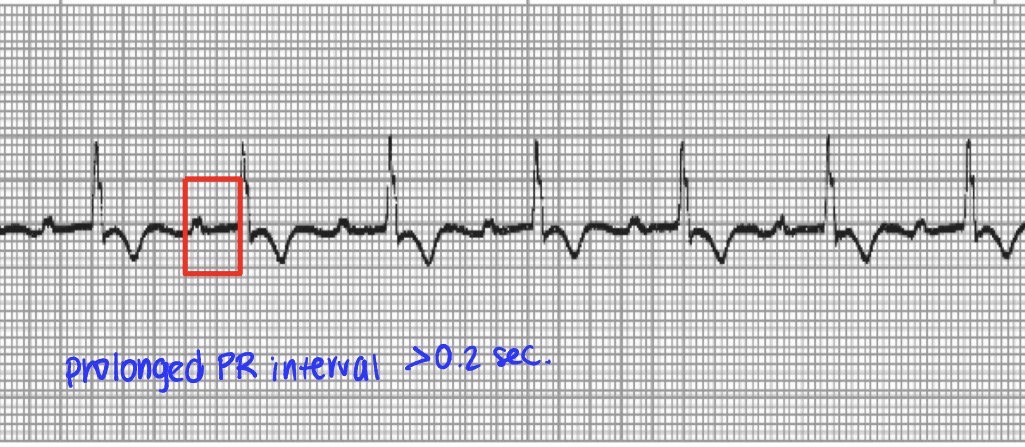 <p>First degree AV block</p>