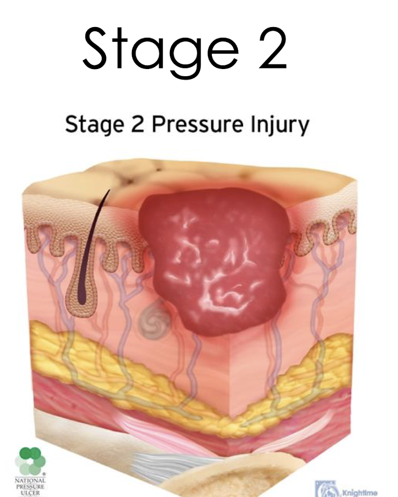<p>Stage 2:</p><ul><li><p>What is it?</p></li><li><p>Describe the wound bed:</p></li><li><p>The wound bed may also present as what?</p></li><li><p>What is NOT visible/present?</p></li></ul><p></p><p></p>
