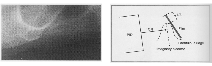 <p>Paralleling → cotton rolls must be placed on BOTH sides of the BB to substitute missing teeth</p><p>Bisecting </p><ul><li><p>Edentulous ridge and film form the angle to be bisected</p></li></ul><ul><li><p>a third of the edge of the film should extend beyond the edentulous ridge </p></li><li><p>Bisecting is recommended if alveolar ridges of the client are severely resorbed. </p></li></ul><p></p>