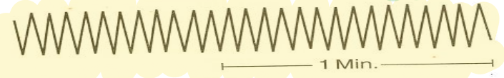 <p>What type of breathing is this?</p>