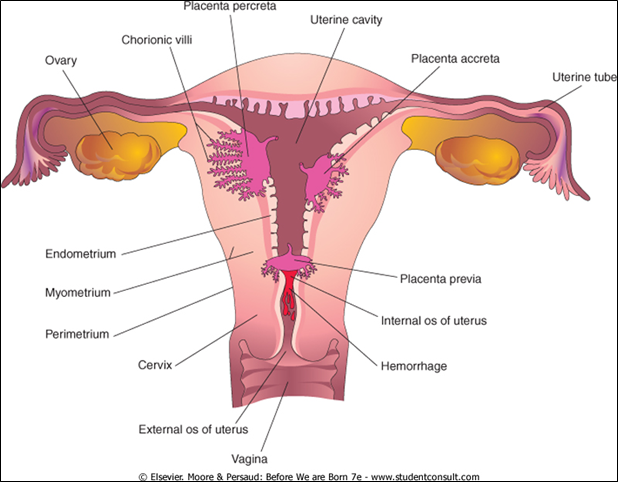 <p>Occurs when the <strong>placenta covers the internal cervical os</strong>, leading to <strong>third-trimester bleeding</strong> and often requiring a <strong>Cesarean section</strong>.</p>