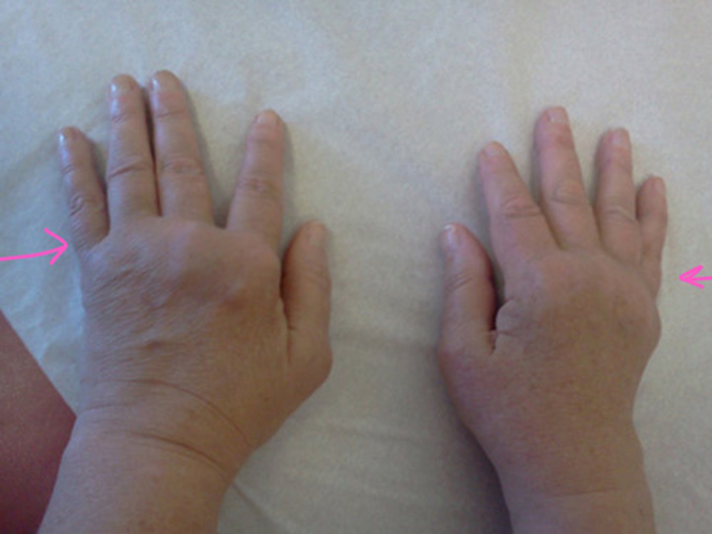 <p>what are the sxs/s of rheumatoid arthritis?</p>