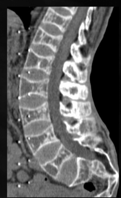 <p>what is seen here for this case of osteoporosis?</p>