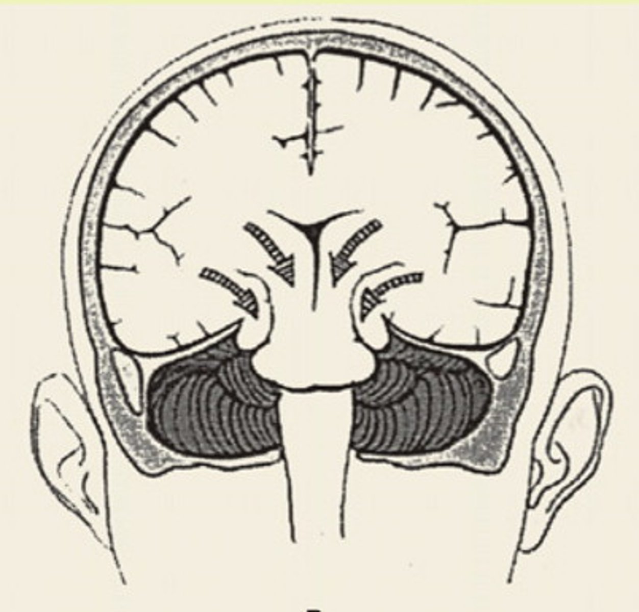<p>transtentorial herniation where the diencephalon and midbrain are pushed downward onto the brainstem</p>