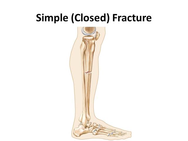 bone breaks