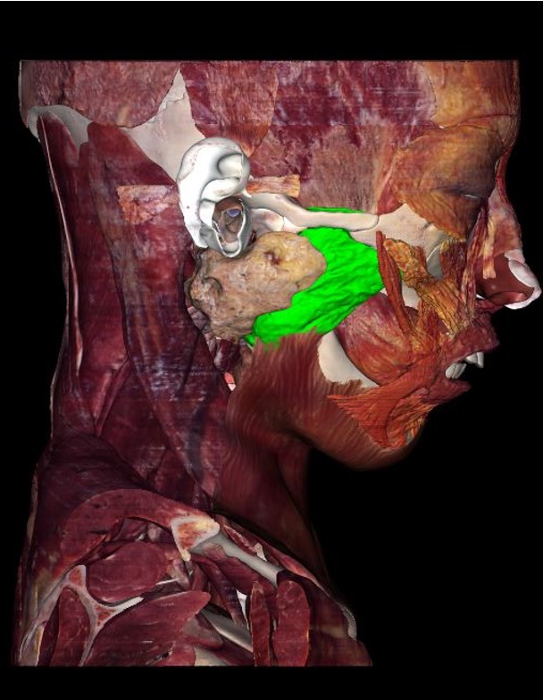 <p>origin: zygomatic arch</p><p>insertion: lateral mandible</p><p>innervation: CN V (trigeminal mandibular division)</p><p>action: elevate mandible to occlude teeth</p>