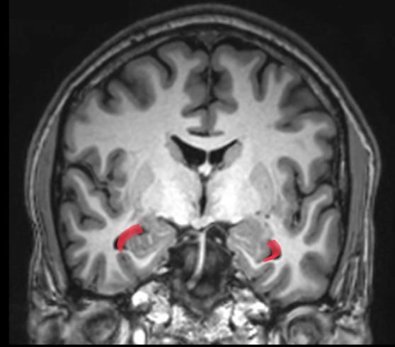 <p>3cm to temporal pole (most anterior part of temporal lobe)</p><p>contains choroid plexus</p>