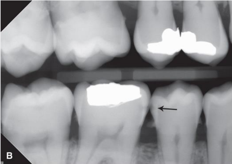 <p>classify this lesion according to the ADA and ICDAS/ICCMS systems </p>