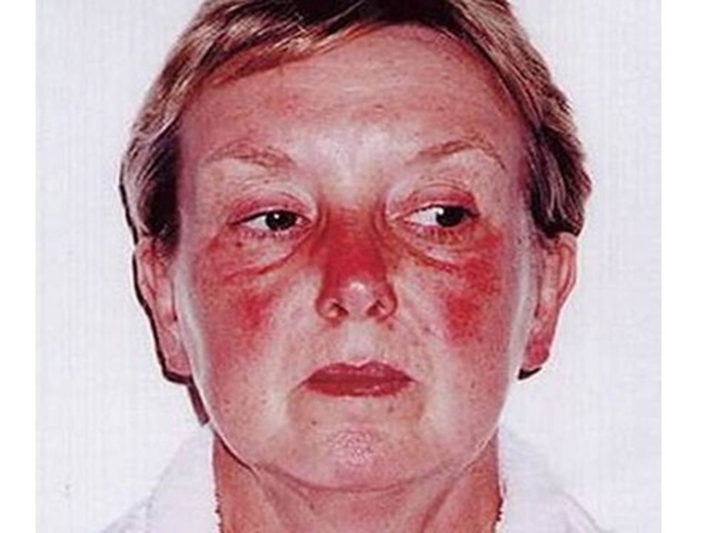 <p>an autoimmune disorder characterized by a red, scaly rash on the face and upper trunk "butterfly rash" on face when exposed to sun, attack kidneys, joints, hearts, and lungsTx with immounsuppression</p>