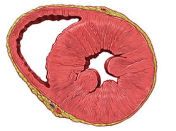 <p>Pathologic Hypertrophy</p>