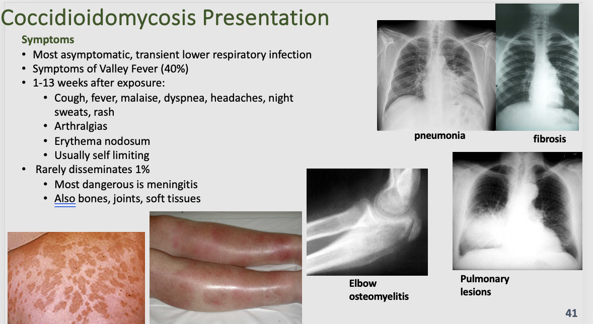 <ul><li><p><mark data-color="blue">Attributes:</mark></p><ul><li><p>Generally, southwestern US</p></li><li><p>Washington State through Mexico, several locations in South America</p></li><li><p>Grows as mold beneath desert surface</p></li><li><p>Dry conditions causes mold to fracture into spores</p></li><li><p>Not spread person to person</p></li></ul></li><li><p><mark data-color="red">Pathogenesis:</mark></p><ul><li><p>Inhalation of spores, 10-50</p></li><li><p>Symptoms begin 1-4 weeks after inhalation</p></li><li><p>Spores enlarge to spherule</p></li><li><p>Spherules produce and release endospores</p></li><li><p>Each endospore produces another spherule, in lungs or other tissues</p></li><li><p>Macrophages carry endospores to other sites: bones, joints, soft tissues, CNS</p></li></ul></li><li><p><mark data-color="yellow">Clinical Presentation:</mark></p><ul><li><p>Most asymptomatic, transient lower respiratory infection</p></li><li><p>Symptoms of San Joaquin Valley Fever or Valley Fever (40%)</p><ul><li><p>Cough, fever, malaise, dyspnea, headaches, night sweats, rash</p></li><li><p>Arthralgias</p></li><li><p>Erythema nodosum</p></li><li><p>Usually self limiting</p></li></ul></li><li><p>Rarely disseminates 1%</p><ul><li><p>Most dangerous is meningitis</p></li><li><p>Also bones, joints, soft tissues</p></li></ul></li></ul></li><li><p><mark data-color="purple">Presentation:</mark></p><ul><li><p>Clues: endemic area, pneumonia/URT disease that isn’t treatable with antibiotics, +/- rash and other symptoms</p></li></ul></li><li><p><mark data-color="green">Diagnosis/Treatment:</mark></p><ul><li><p><strong>Most Common Dx methods:</strong></p><ul><li><p>Serology for Ab (IgM, IgA)</p></li><li><p>Ag in blood and urine</p></li><li><p>Culture and staining</p></li><li><p>Tissue Histology</p><ul><li><p><strong><mark data-color="green">Spherule</mark></strong><mark data-color="green">: Classic pathology finding: Spherule filled with endospores “Cocci Cactus”</mark></p></li></ul></li><li><p>Imaging</p></li></ul></li><li><p><strong>Treatment</strong></p><ul><li><p>Africa American or Filipino descent-more likely to have extrapulmonary complications</p></li><li><p>Mild disease: no need to treat</p></li><li><p>Moderate disease:</p><ul><li><p>Flucanazole (400 mg daily) for 6 to 12 weeks</p></li></ul></li><li><p>Severe:</p><ul><li><p>intravenous amphotericin B in combination with Flucanazole 400 to 800 mg daily until stable and transition to Flucanazole (400 mg daily) for 12 to 14 weeks</p></li></ul></li><li><p>Immunocompromised (regardless of severity)</p><ul><li><p>Same as above but with extended time or lifelong treatment</p></li><li><p>Consult with ID specialist regarding tx of immunocompromising condition with coccidioidomycosis for specific tailored treatments of multiple conditions</p></li></ul></li></ul></li></ul></li></ul>