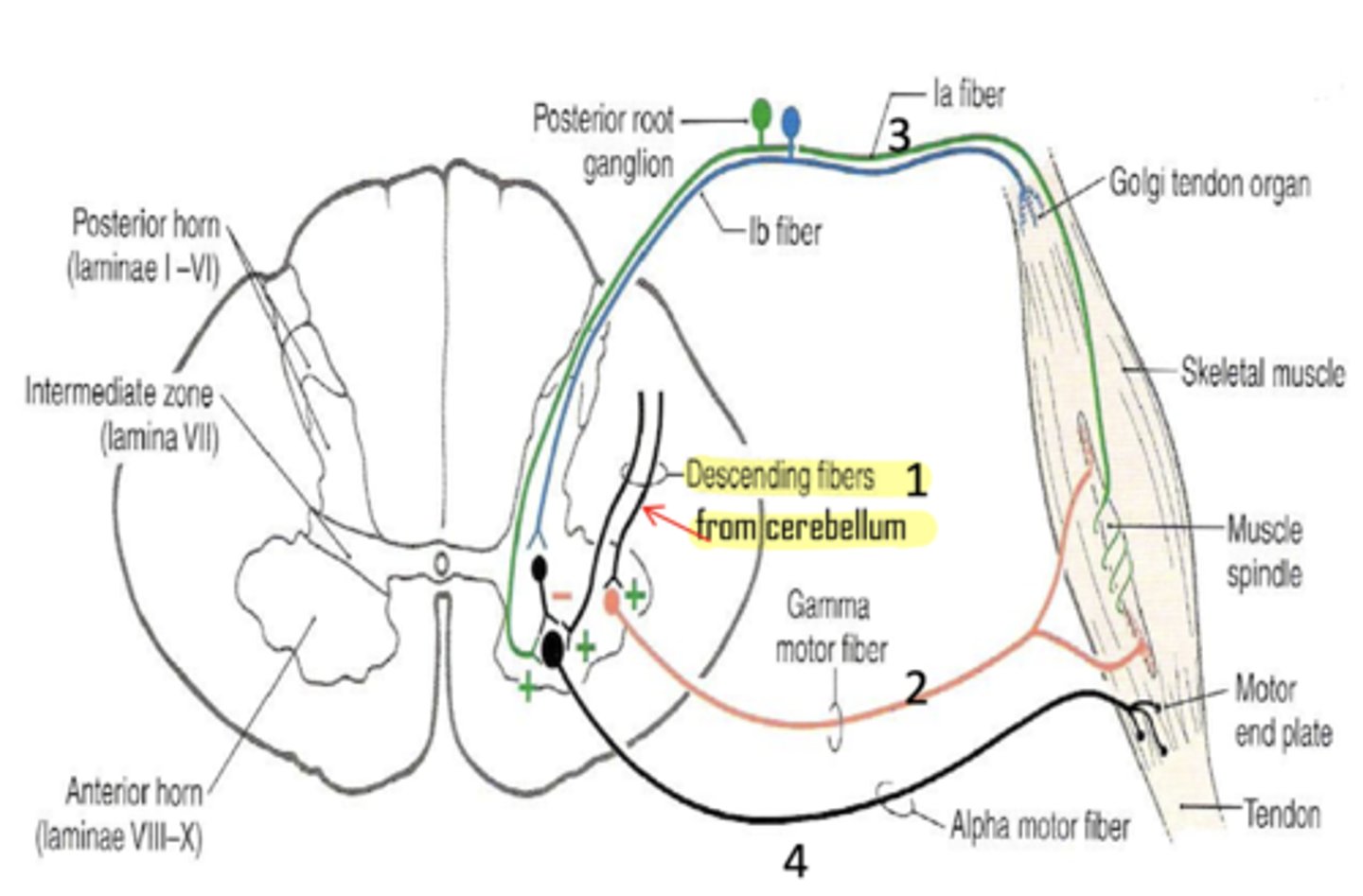 <p>upper motor neuron (from BA 4) cannot inhibit descending cerebellar fibers</p>