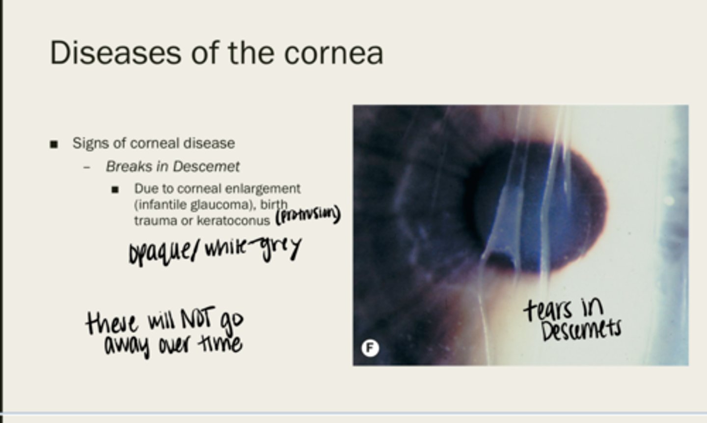 <p>due to corneal enlargement (infantile glaucoma), birth trauma, or keratoconus</p>