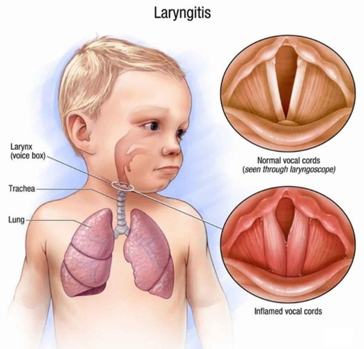 <p>-upper respiratory infection</p><p>-inflammation of the larynx</p><p>-self limiting (meaning that it gets better on its own)</p><p>-worst case scenario is that the larynx swells so much that breathing stops</p>