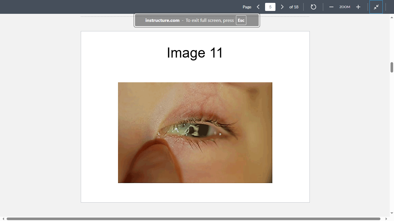 <p>This baby (Image 11) was born to a woman who had had no prenatal care. Culture of the discharge on Thayer-Martin agar grew an isolate that was oxidase positive and utilized glucose, but not maltose. Gram-stained smear of the isolate was likely to show which of the following microscopic morphologies?</p>