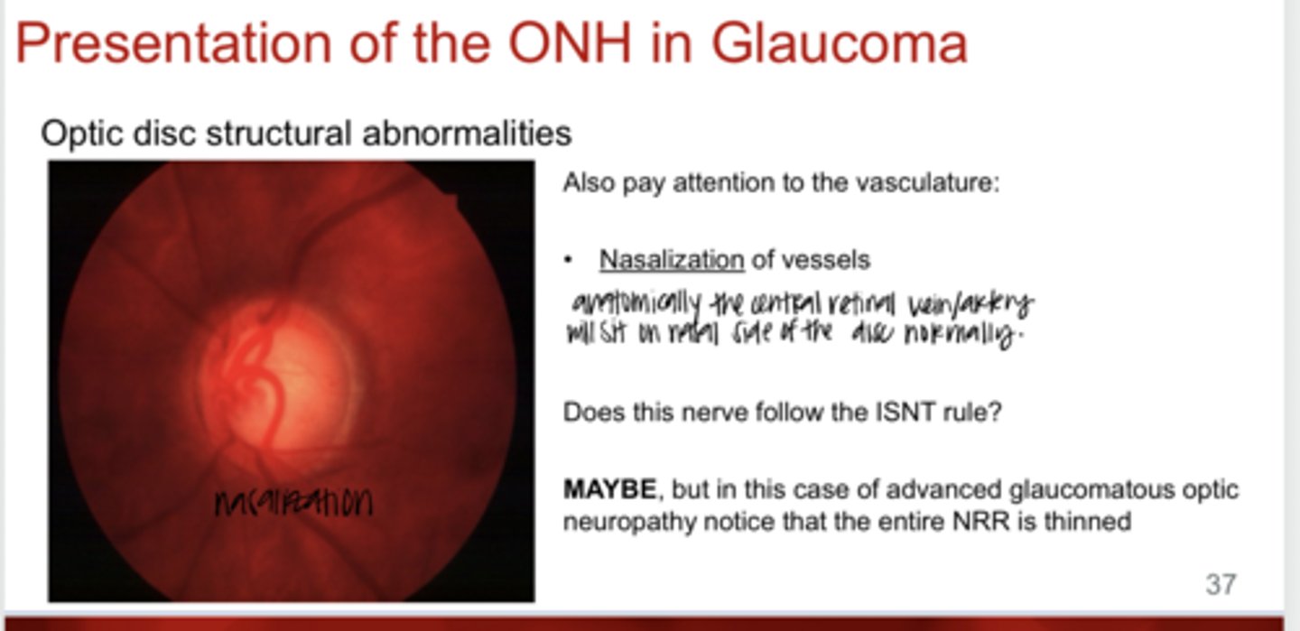 <p>What is nasalization of vasculature in glaucoma?</p>