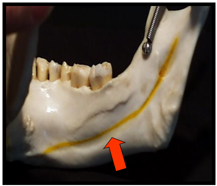 <p><span>A scooped-out depressed are of bone located on the internal surface of the mandible, inferior to the mylohyoid ridge.</span></p>