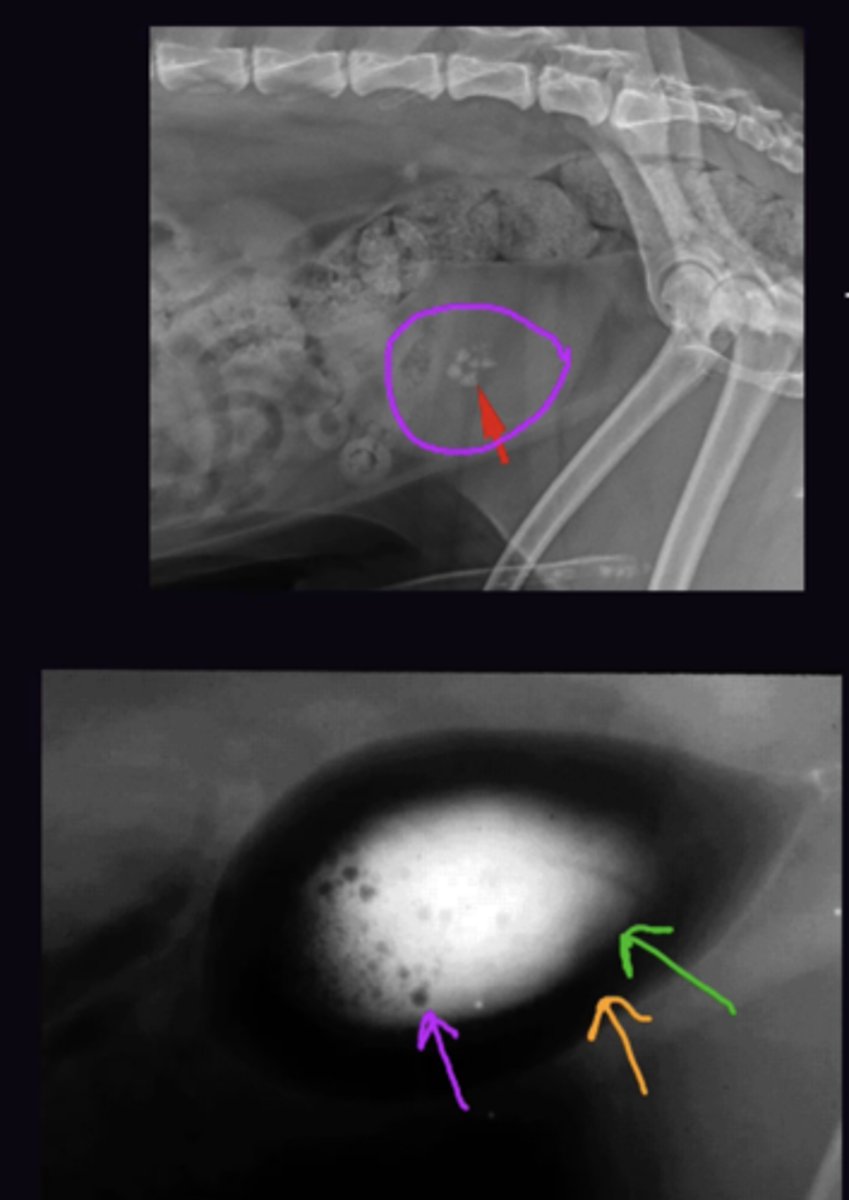 <p>Occurs when Structure is Surrounded by Positive Contrast</p><p>e.g calculi are mineral opaque in the bladder as they are in urine (Soft tissue opacity). In a double contrast cystogram, the calculi (mineral opacity) appear relatively lucent compared to the contrast agent (Metal Opacity).</p><p>e.g. Nipple surrounded by gas so appears opaque</p>