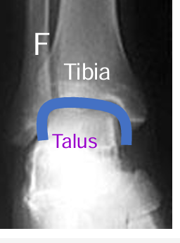 <ul><li><p>The ankle mortice is a U-shaped structure making up the top of the talocrural joint </p></li><li><p>Made up of: </p></li><li><p>Lower end of tibia </p></li><li><p>Medial malleolus (Tibia) </p></li><li><p>Lateral malleolus  (Fibula) </p></li><li><p>Lateral malleolus longer and more posterior than medial</p></li></ul><p></p>