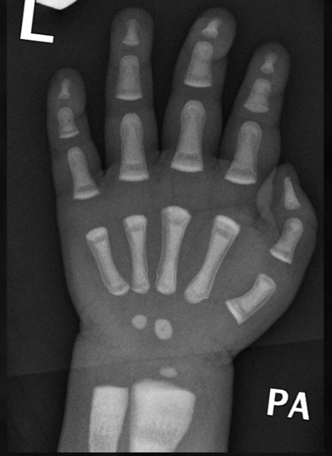 <p>what is seen here for this case of osteopetrosis?</p>