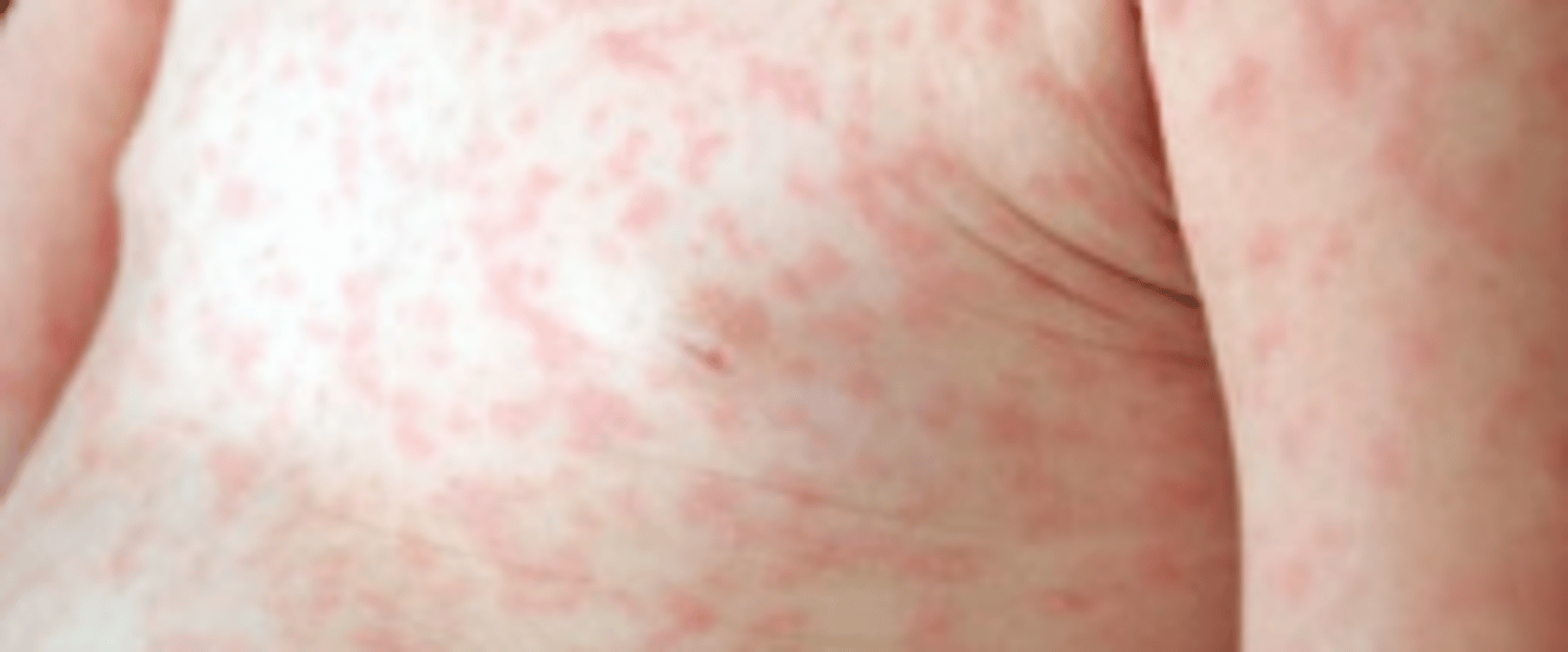 <p>HHV6</p><p>fever --&gt; rash appears</p>
