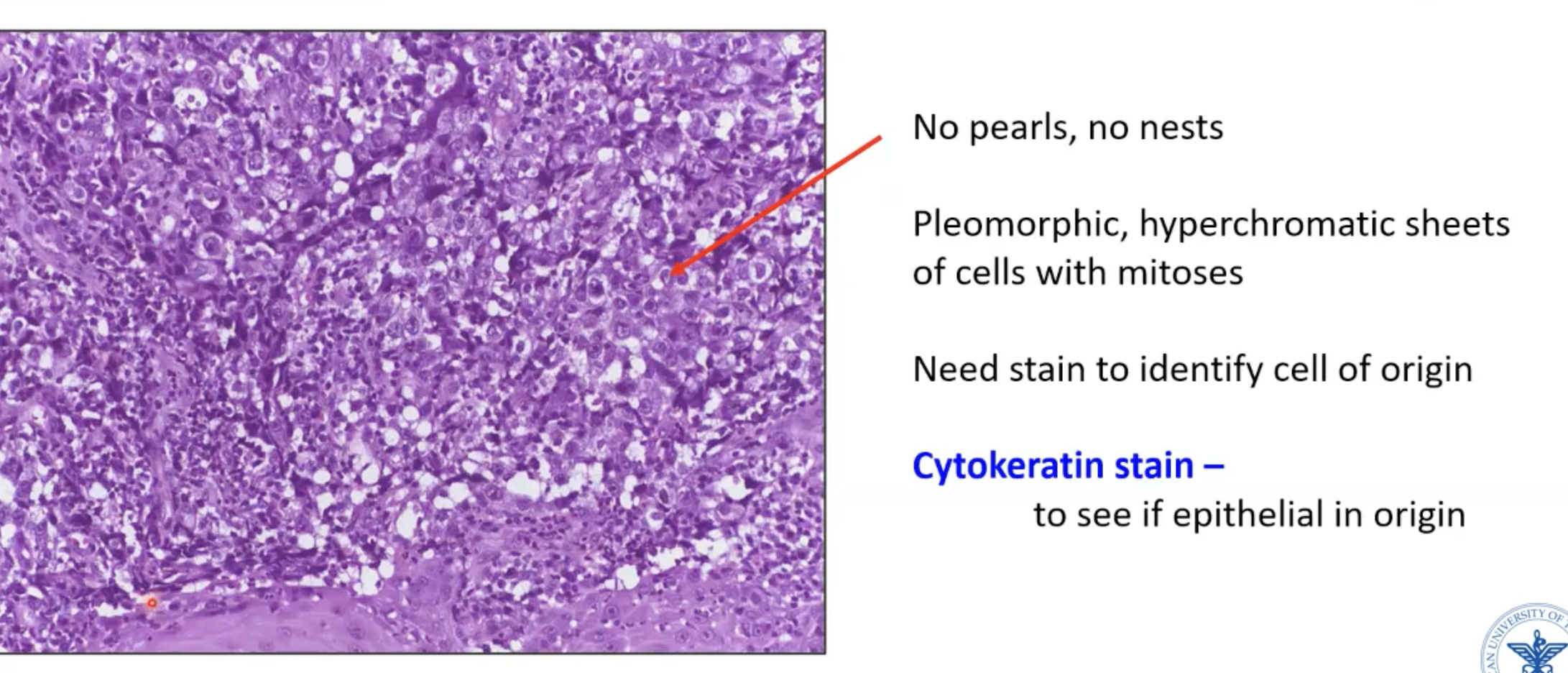 <p>Cell sizes are very different</p><p>No pearls/nests</p><p>Cytokeratin stain would prove whether it is a carcinoma or not</p>