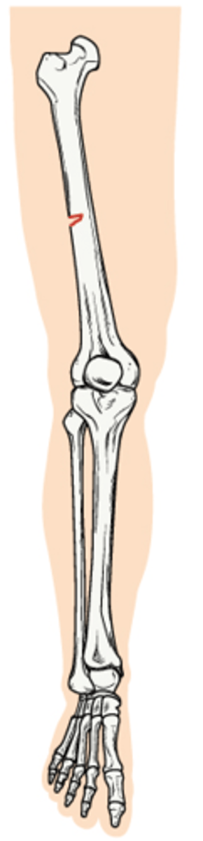 <p>Bending and incomplete break of a bone; most often seen in children</p>