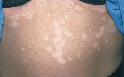 <p>by normal skin flora</p><p></p><p>hypopigmented patchy lesions</p><p></p><p>upper chest/ back, proximal extremities</p>