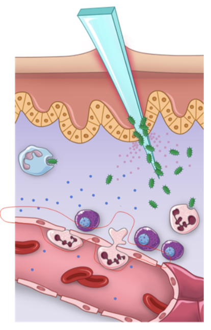 <ul><li><p>the chemotactic factors released by cells during the vasodilation and permeabilization steps induce the recruitment of more immune cells to the site of infection</p></li><li><p>the first type of cells to arrive by chemotaxis to the site of infection are neutrophils</p></li><li><p>when neutrophils are circulating in the blood arrive to an infection site, they adhere to the endothelial cell walls via a process called margination and migrate between the capillary-endothelial cells into the infected tissue by a process called extravasation or diapedesis </p></li></ul><p></p>