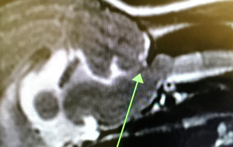 <p>Atlanto-occipital AO or Atlanto-axial junction AA malformations</p>