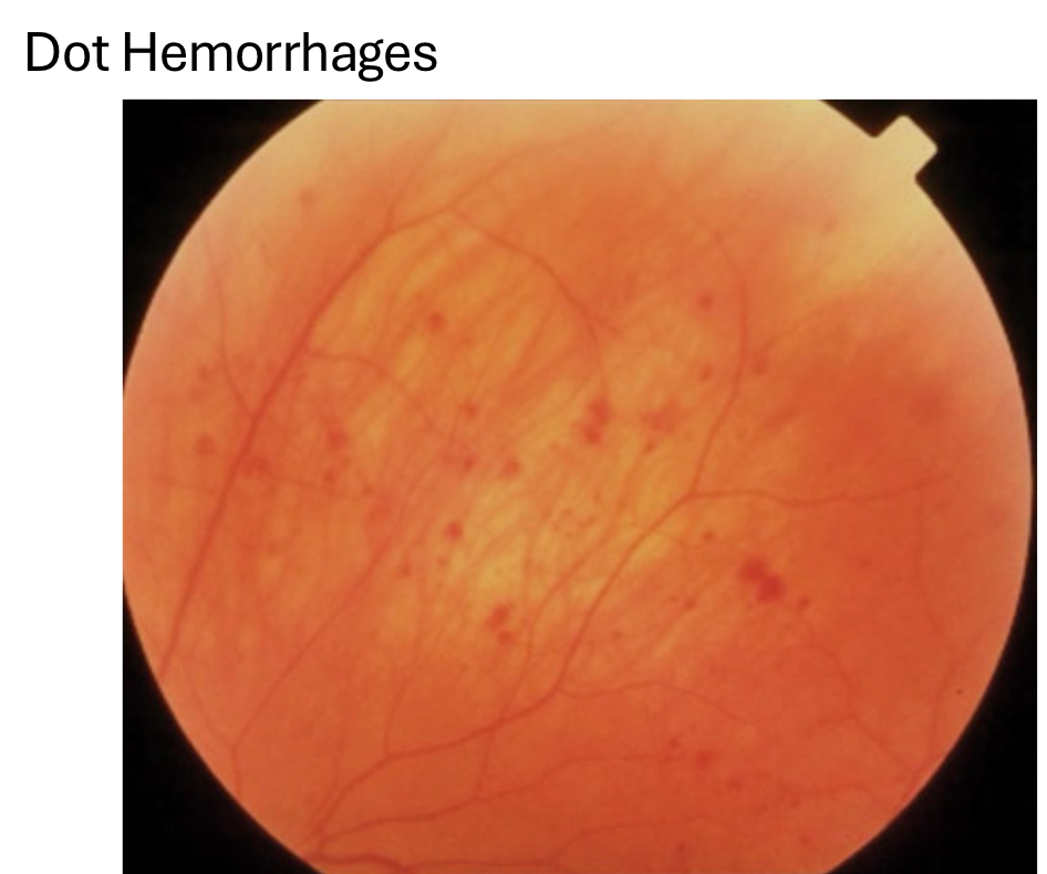 <p>dot hemorrhages</p>