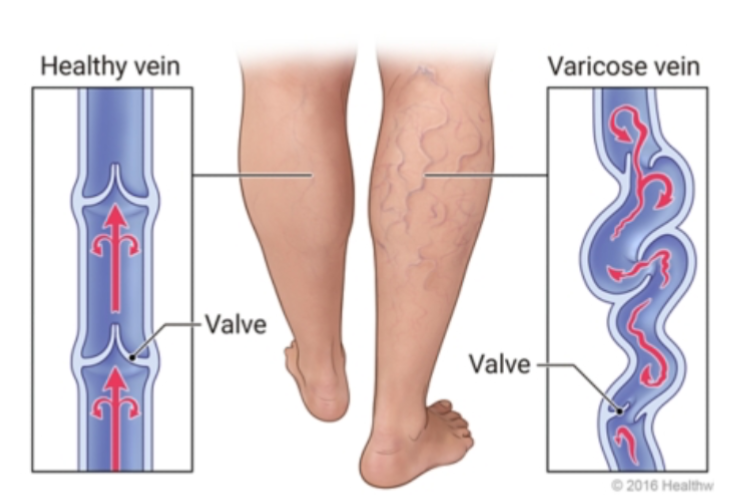 <p>-blood pools in veins causes veins to bend</p><p>-this opens the valves and blood backflow happens</p>