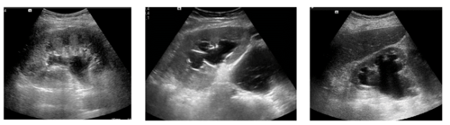 <p>Una ecografía</p><p>IMAGEN DERECHA: HIDRONEFROSIS -&gt; PARENQUIMIA DELGADO POR TIEMPO DE AFECTACIÓN</p>