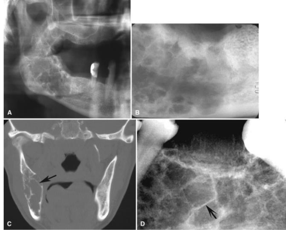 <p>Uncommon benign mesenchymal tumor usually found in the posterior mandible premolar + molar areas; rarely found in ramus and condyle</p>