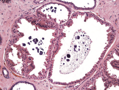 <p>Epitelio atrófico aplanado o células apocrinas metaplásicas (abundante citoplasma eosinofilo)</p>