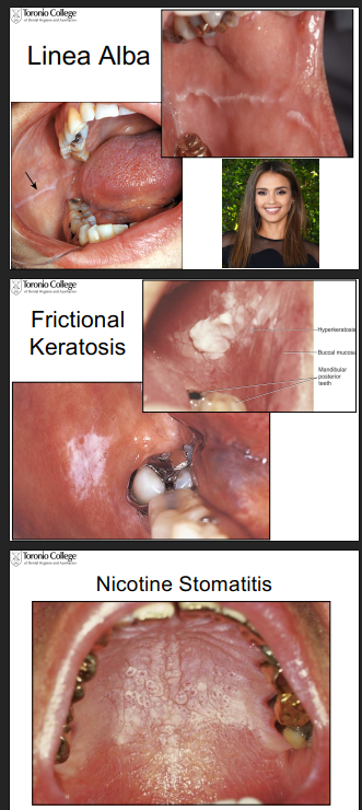 <p>Its the tissue’s response to frictional or chemical trauma (chronic trauma)</p><p>Examples: </p><p>linea alba = a line where max and mand teeth occlude</p><p>frictional keratosis = tissue response to teeth grinding or cheek biting (looks white, thickened, textured) </p><p>gingival fibrosis = toughing of the gums</p><p>nicotine stomatitis = damage to tissues from heat of smoking </p>