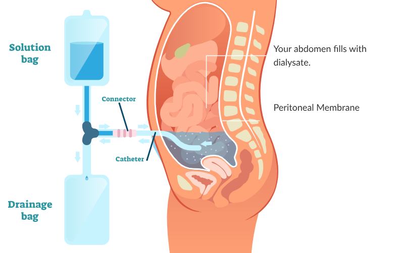 <ul><li><p>Dialysis is conducted across the <strong>peritoneum</strong>, the <strong>membrane</strong> which lines the <strong>abdomen </strong>of the <strong>patient</strong></p></li><li><p><strong>Dialysis fluid</strong> is introduced into the abdomen via a <strong>catheter</strong> and left for several hours</p></li><li><p>Urea and excess mineral ions in the blood cross the peritoneal membrane into the dialysis fluid, which is then drained out</p></li></ul><p></p>