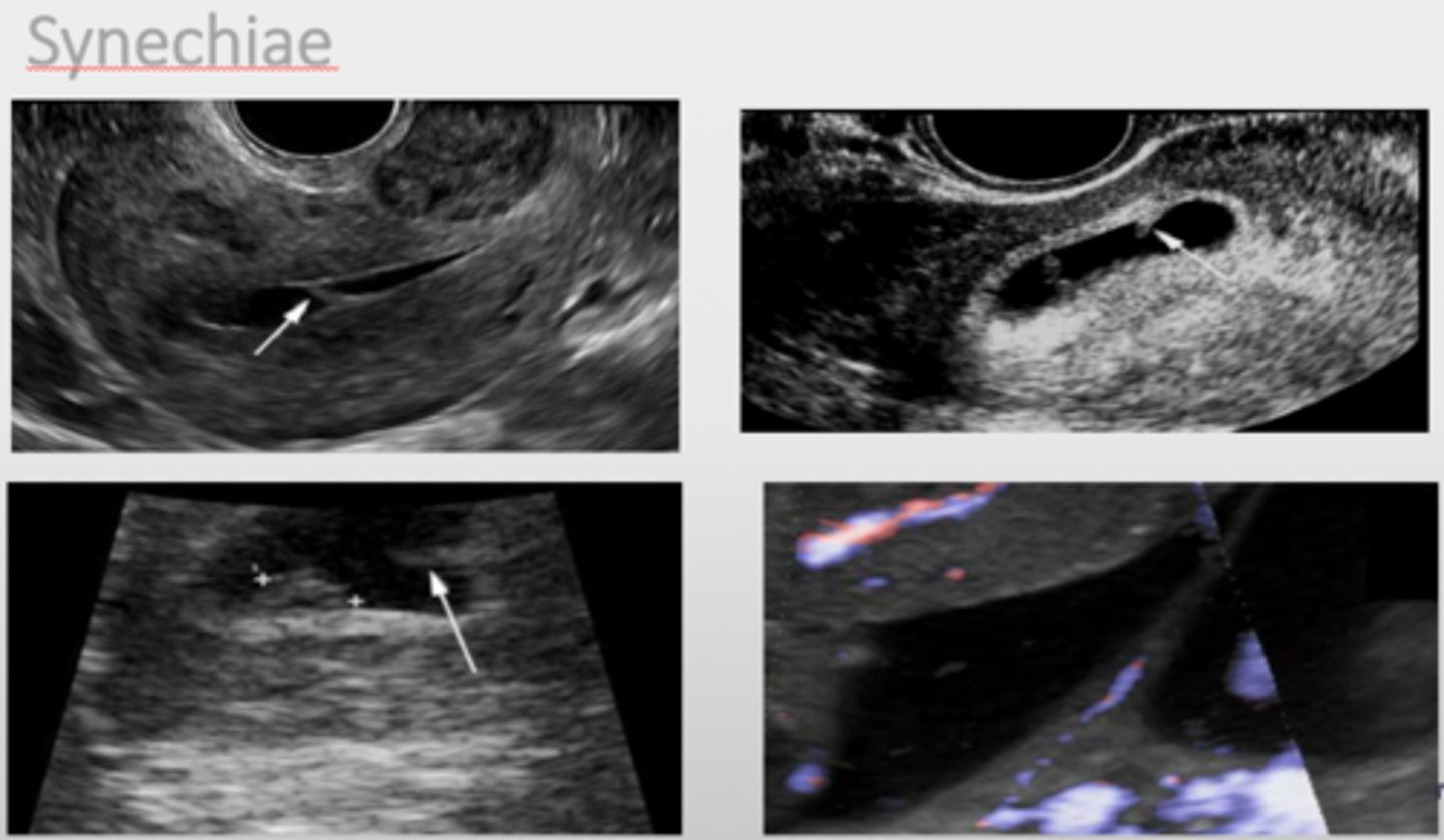 <p>Adhesions of the endometrium develop as a result of trauma to the uterine lining.</p>