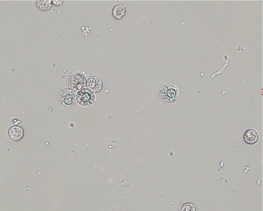 <p>absorbs water and begins to swell which causes brownian movement and forms a glitter cell (NONPATHOLOGICAL)</p>