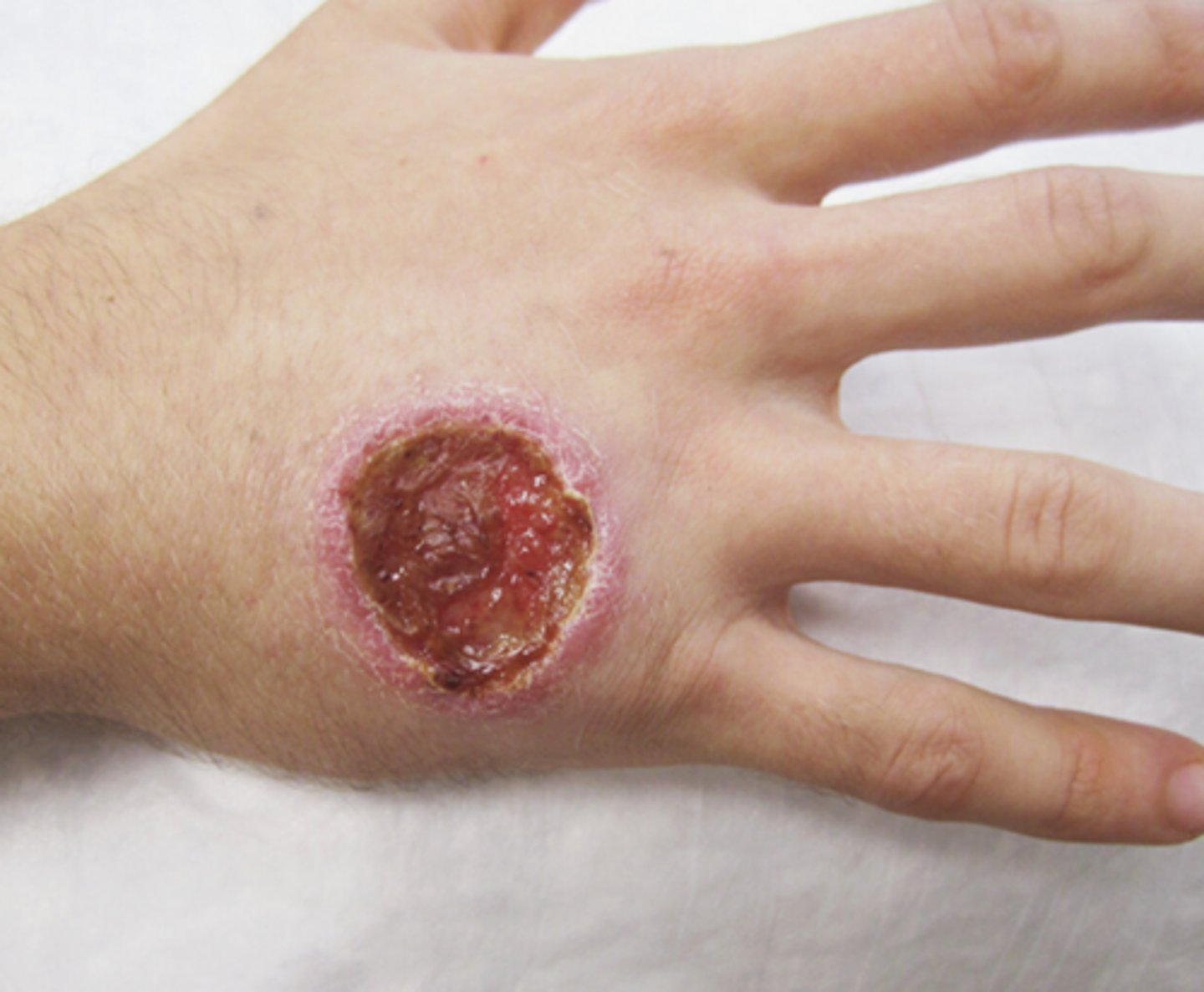 <p>"Oriental Sore" (painless ulcer with raised edges)</p>