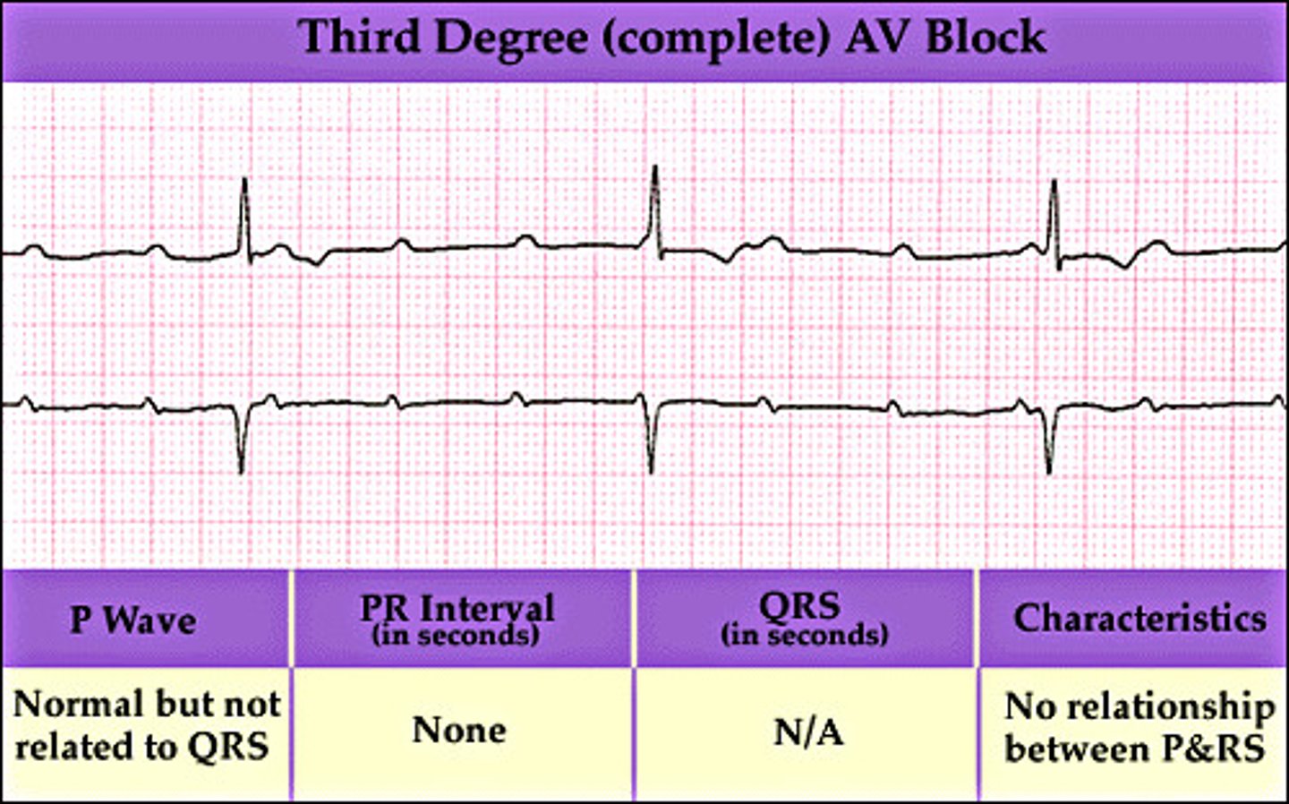 <p>Third-degree AV block</p>