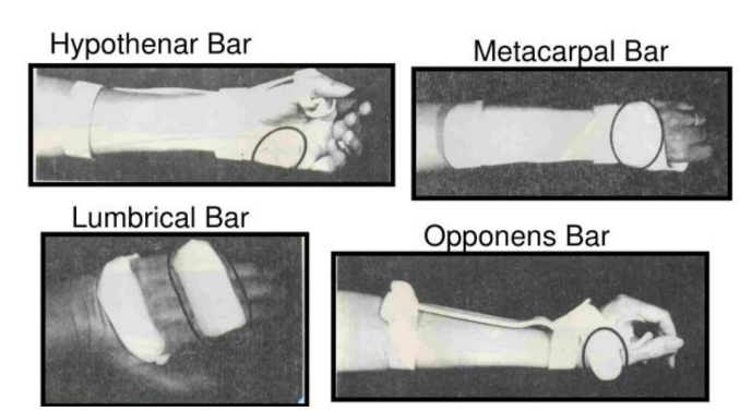 <p><strong>Anatomic bar</strong></p><ul><li><p>It is placed over a joint to immobilize to achieve therapeutic goals</p></li><li><p>Provide connections to forearm trough</p></li></ul><p></p>