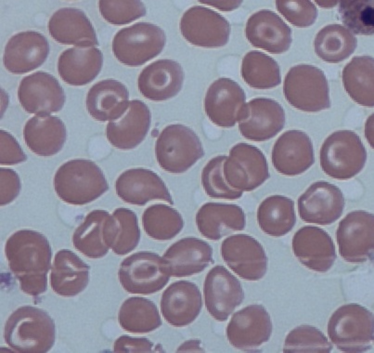 <p>Sickle-cell/thalassaemia</p><p>Iron-deficiency anaemia</p><p>Hyposplenism</p><p>Liver disease</p>