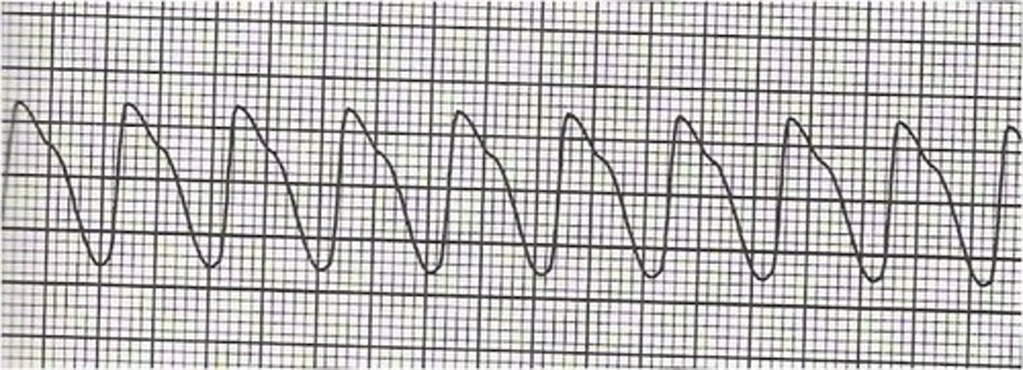 <p>no p waves and WIDE QRS</p>
