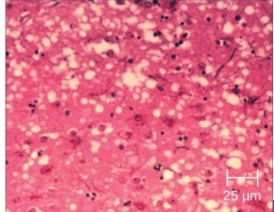 <p>No genomic material; <strong>misfolded proteins that can cause others to become misfolded.</strong> eg <span><em>transmissible spongiform encephalopathy</em> (i.e.</span><br><span>mad cow disease)</span></p>