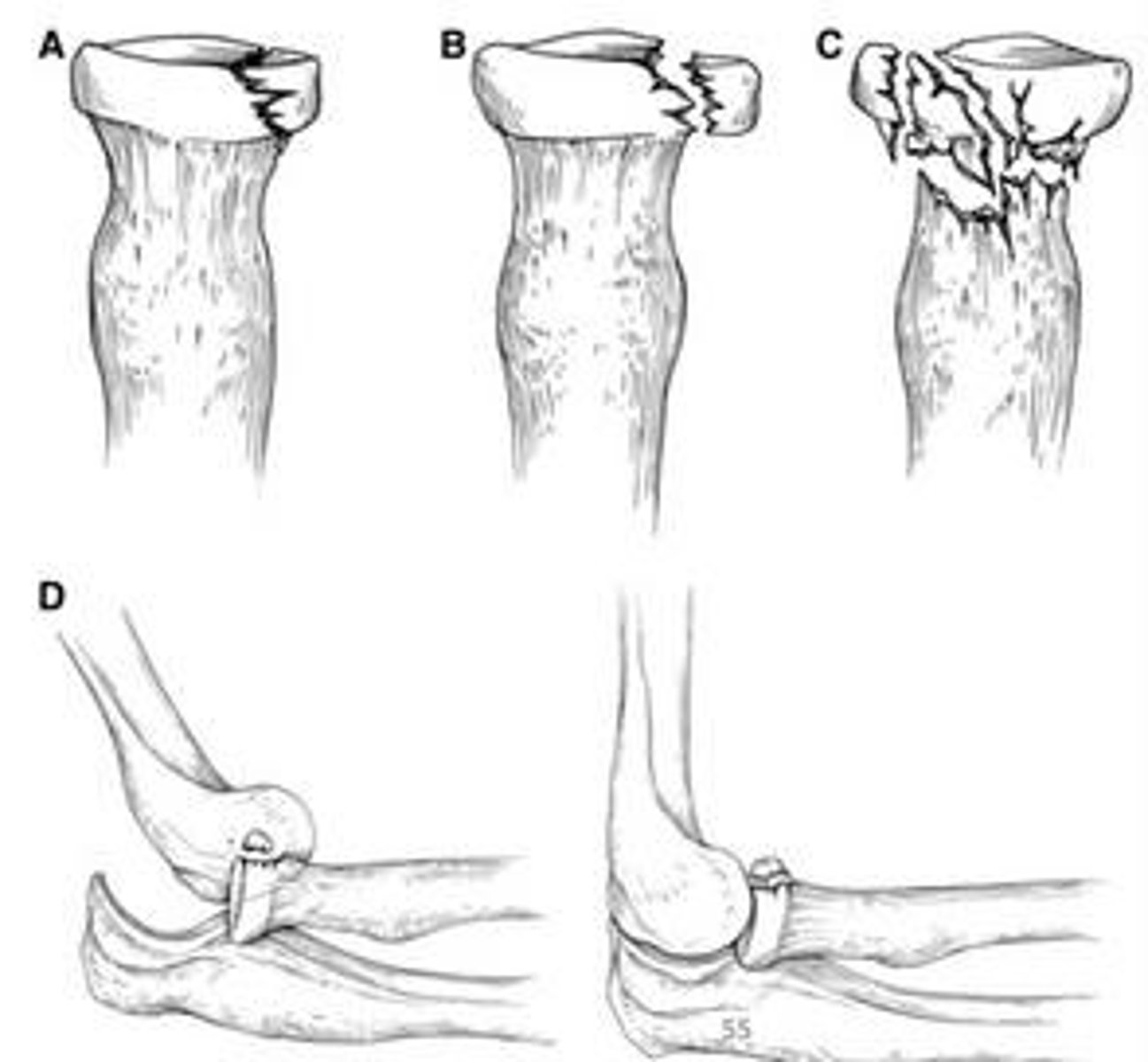 <p>Fracture of the radial head, coronoid fracture, and elbow dislocation.</p>