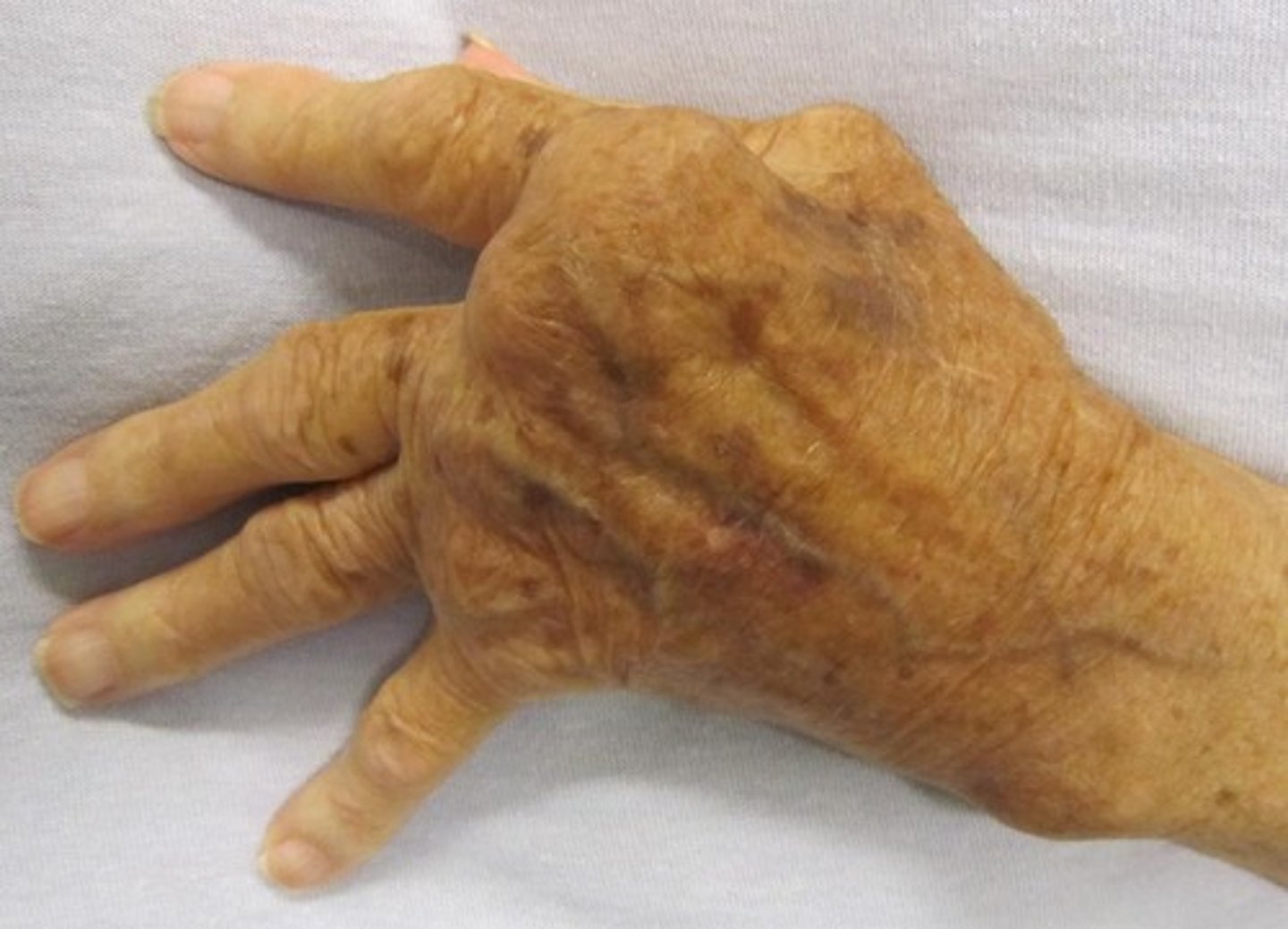 <p>Fingers kind of bend towards the ulnar side of your hand. Here is a picture so you can kind of get an idea of how it looks like.</p>