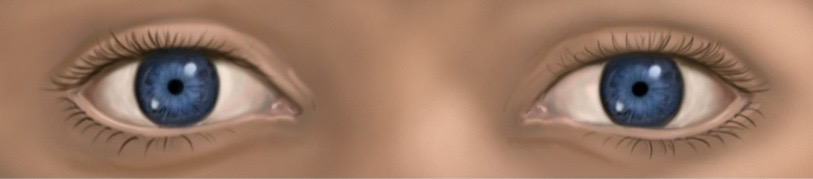 <p>associated with narcotic use and glaucoma treatment via pilocarpine drops</p>