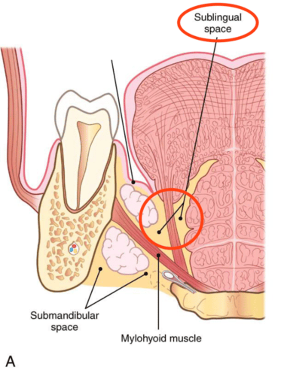 <p>- When infection drains above the mylohyoid muscle</p><p>- Usually mandibular teeth</p>