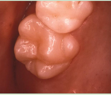 <p>Accessory cusp on palatal surface of <strong>ML cusp of maxillary molars </strong></p>